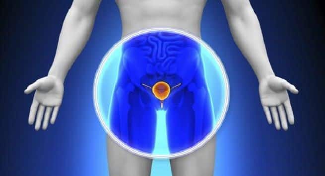 Benign Prostatic Hyperplasia: Can Early Detection Lead To Treatment?